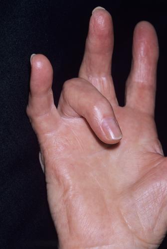 Triệu chứng của hội chứng ngón tay lò xo