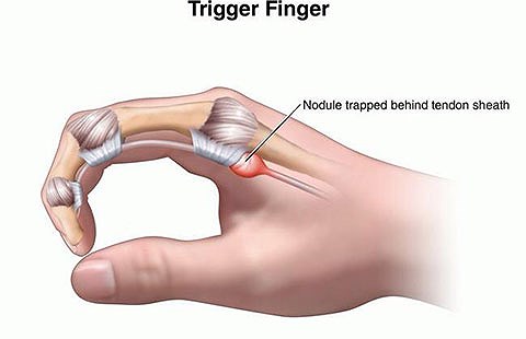 Hội chứng ngón tay lò xo (Trigged finger)