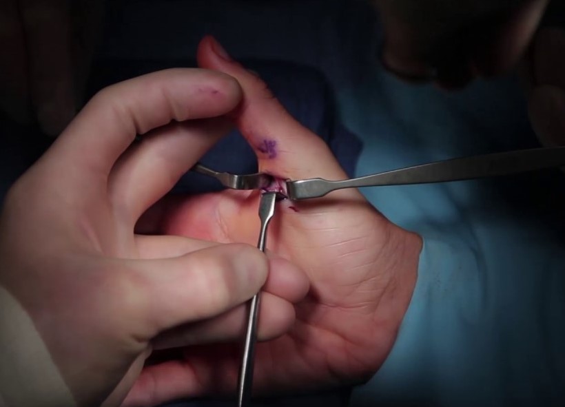 Phương pháp phẫu thuật chữ trị tình trạng ngón tay không duỗi thẳng được