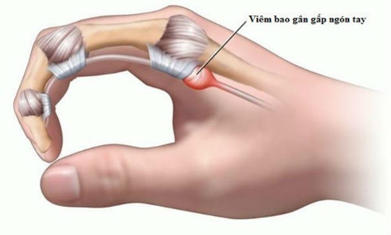 Hội chứng ngón tay lò xo cần phải sử dụng nẹp ngón tay.