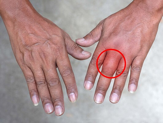 Ngón tay bị sưng là bệnh lý gì?
