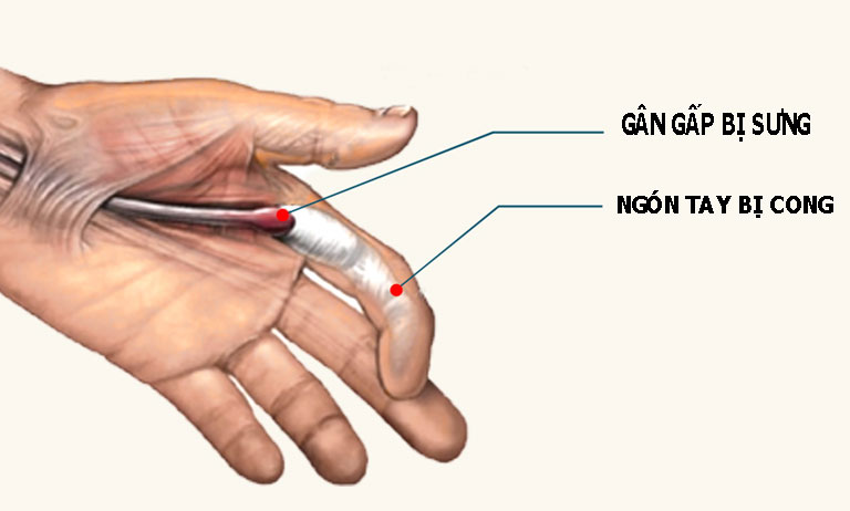 Hình ảnh người bệnh trong trường hợp tổn thương ở vùng gân gấp sẽ cần sử dụng nẹp ngón tay.