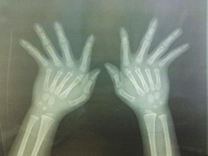 Chụp x-quang để thấy rõ tình trạng cong của tay