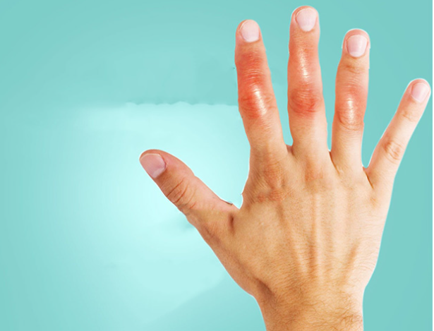 Viêm khớp ngón tay gây ra tình trạng biến dạng ngón tay.