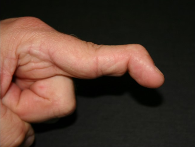 Các yếu tố nguy cơ gây ra ình trạng ngón tay không duỗi thẳng được