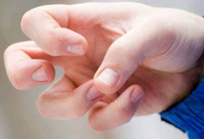 Ngón tay cong là một biến dạng uốn cong của đầu ngón tay xảy ra ở khớp liên đốt xa