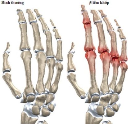 Viêm khớp ngón tay - nguy cơ gây biến dạng cấu trúc xương