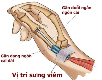 Khi mắc phải hội chứng de quervain, bệnh nhân có thể sẽ bị đau khi vận động xoay cổ tay, nắm bất cứ vật gì