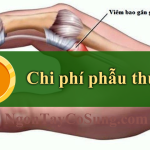 Chi phí phẫu thuật ngón tay cò súng