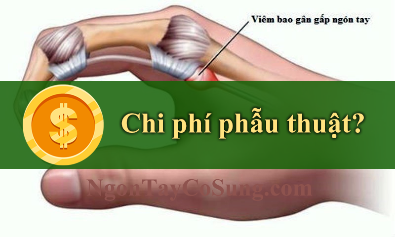 Chi phí phẫu thuật ngón tay cò súng