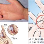 Ngón tay cò súng có nguy hiểm không?
