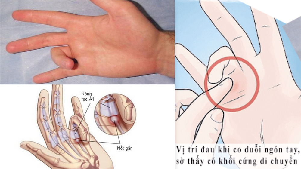 Ngón tay cò súng có nguy hiểm không?